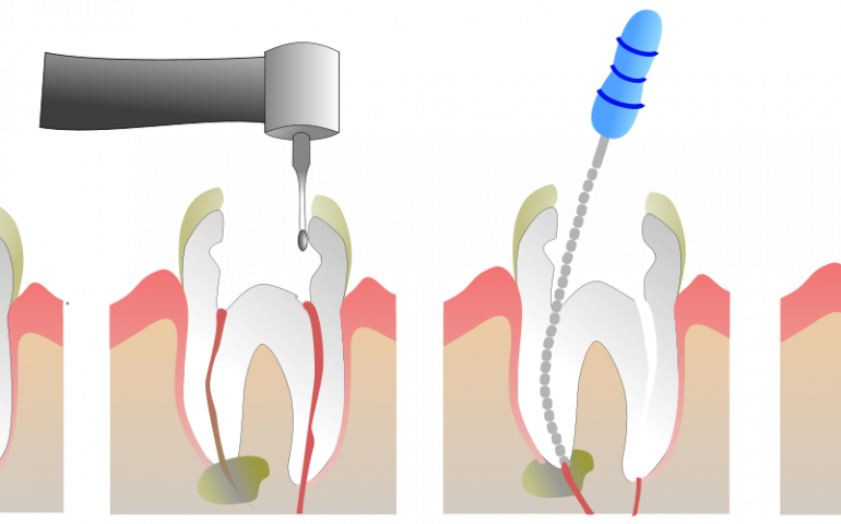 1250px-Root_Canal_Illustration_Molar.svg