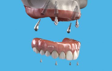 Implantologia dentale