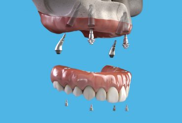 Implantologia dentale